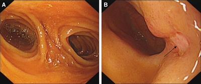 A rare cause of gastrointestinal bleeding in adults: Ileal duplication with ulceration: A case report and review of literature